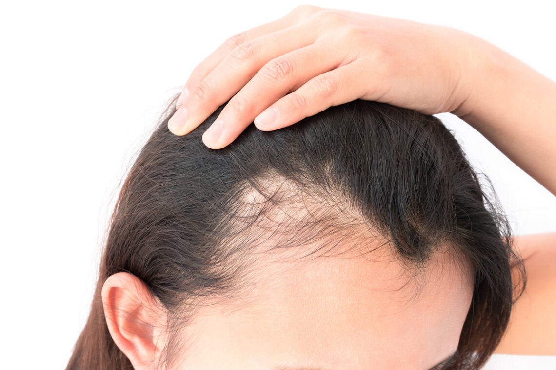 Symptoms Of Hair Thinning