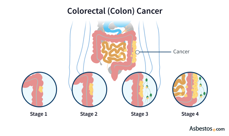 Bowel Cancer | Colorectal Cancer